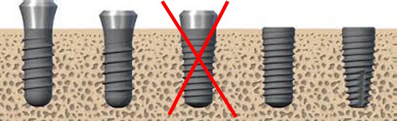 Straumann Drops TE Implant by December 2021 – OSSEOTECH